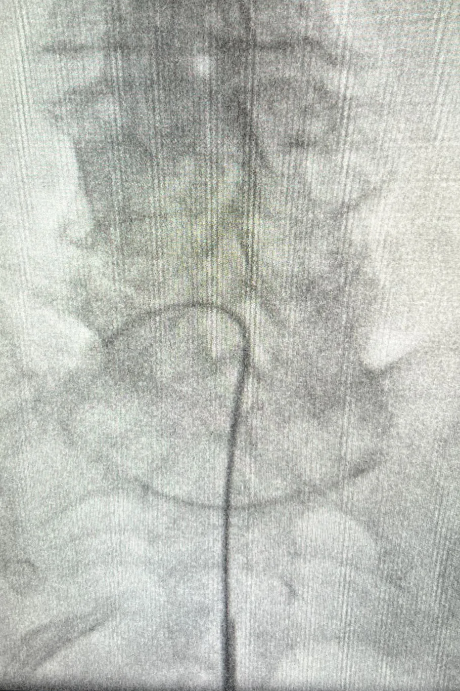 neumoplastia epidural, dolor de espalda