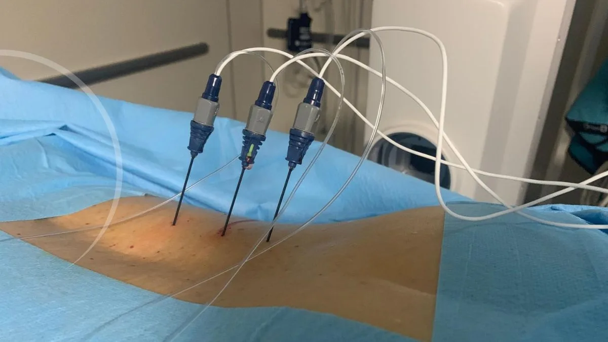 radiofrecuencia del nervio, dolor neuropático