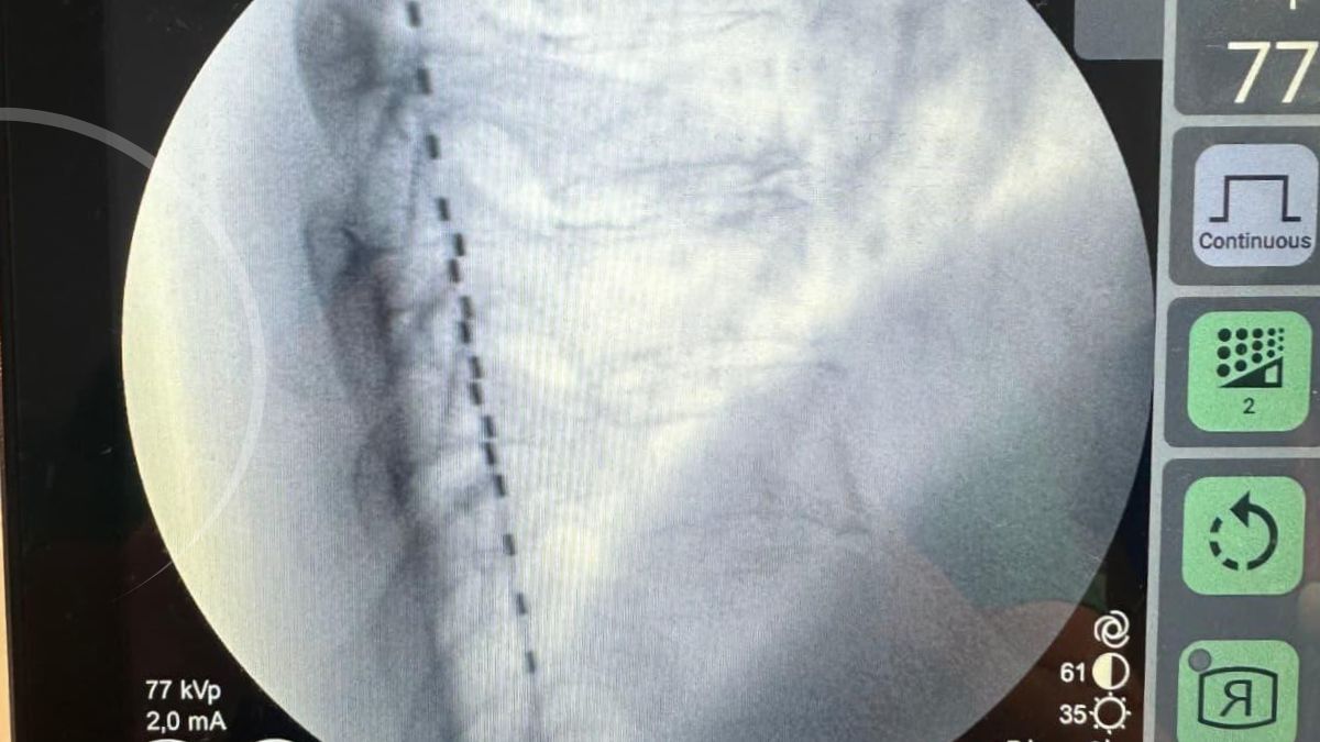 tratamiento del dolor crónico con inteligencia artificial